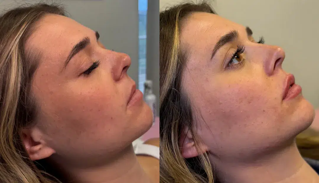 Epicutis Facial before and after photo by Kristin Tarbet MD
