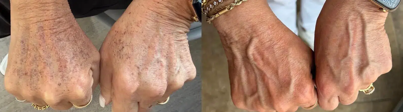 Hand IPL treatment before and after photo by Kristin Tarbet MD