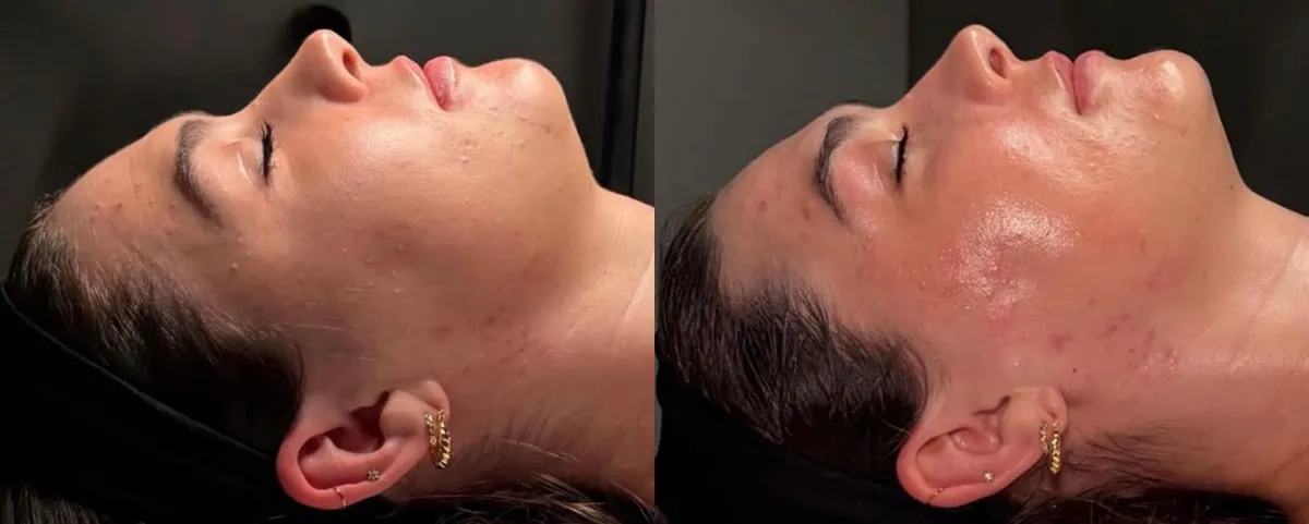 Kysse Lip filler before and after photo by Kristin Tarbet MD