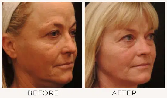 before and after ultherapy results