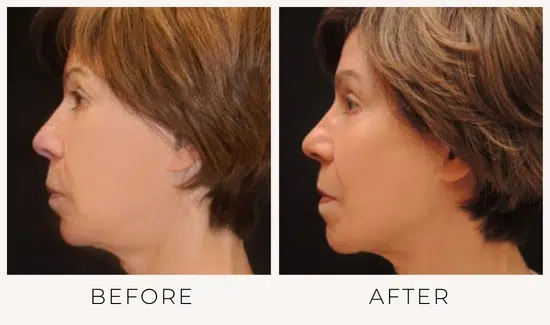 before and after ultherapy results